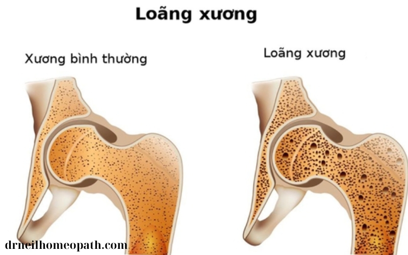 Muối Canxi và vai trò trong phát triển xương (2)